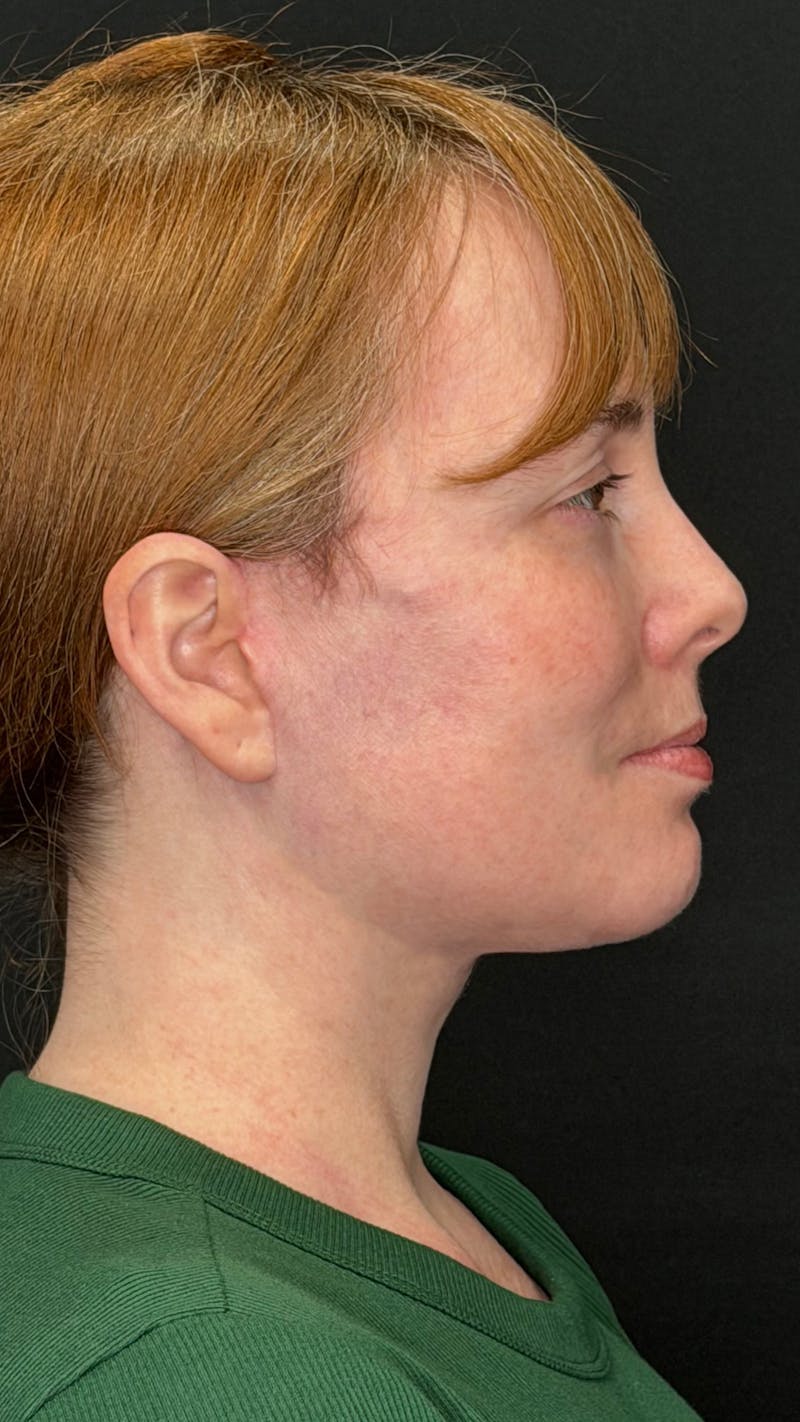Deep Plane Facelift 40s Before & After Gallery - Patient 423590 - Image 8