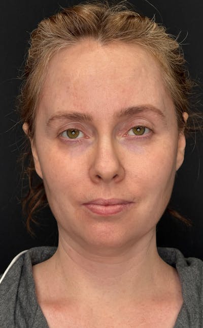 Deep Plane Facelift 40s Before & After Gallery - Patient 423590 - Image 1