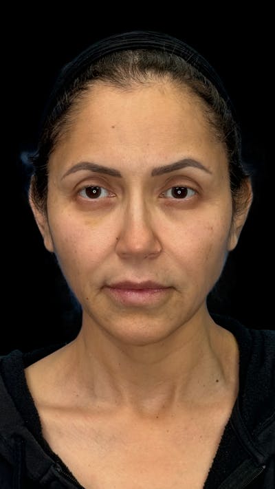 Deep Plane Facelift 50s Before & After Gallery - Patient 210718 - Image 1