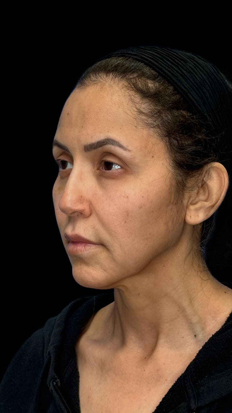 Deep Plane Facelift 50s Before & After Gallery - Patient 210718 - Image 3