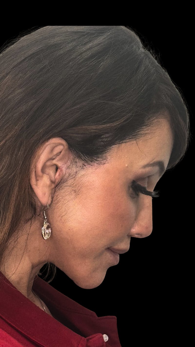 Deep Plane Facelift 50s Before & After Gallery - Patient 210718 - Image 14