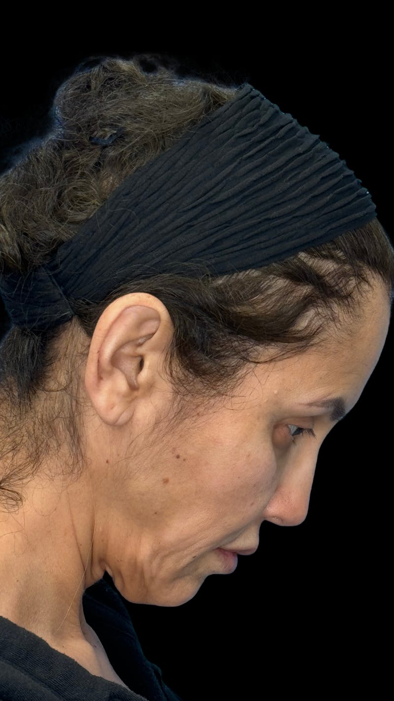 Deep Plane Facelift 50s Before & After Gallery - Patient 210718 - Image 13