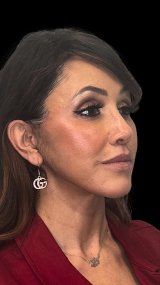 Deep Plane Facelift 50s Before & After Gallery - Patient 210718 - Image 10