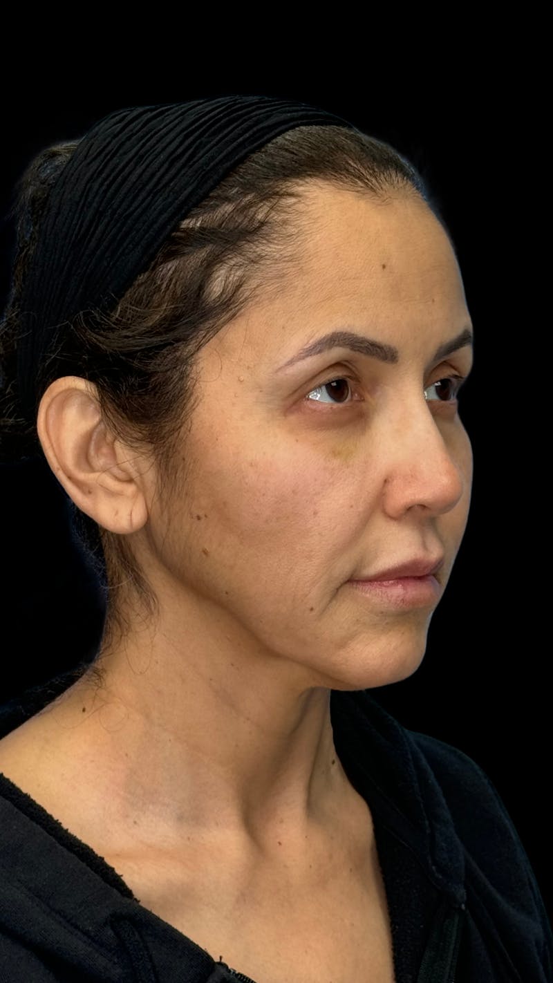 Deep Plane Facelift 50s Before & After Gallery - Patient 210718 - Image 9