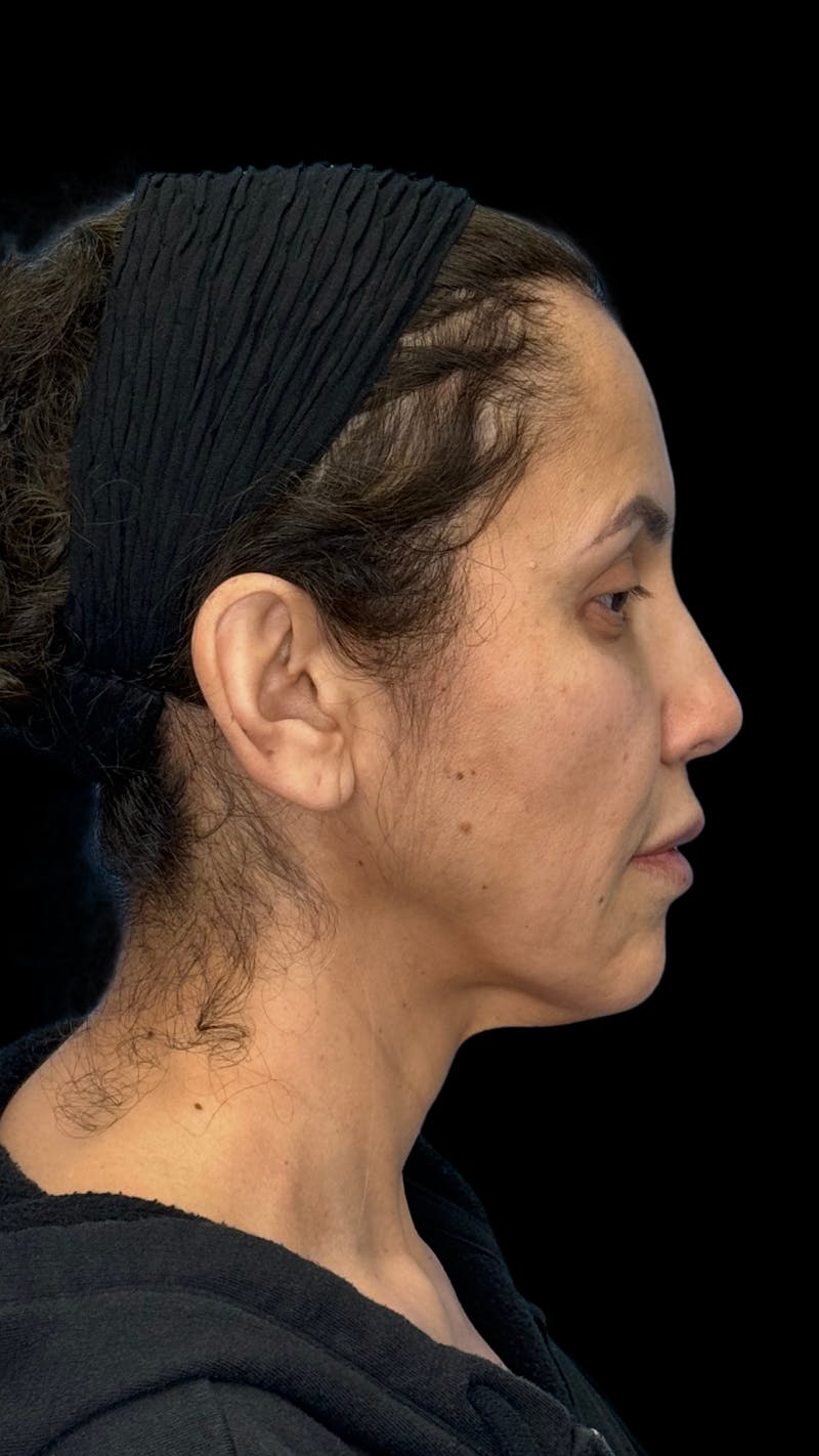 Deep Plane Facelift 50s Before & After Gallery - Patient 210718 - Image 11