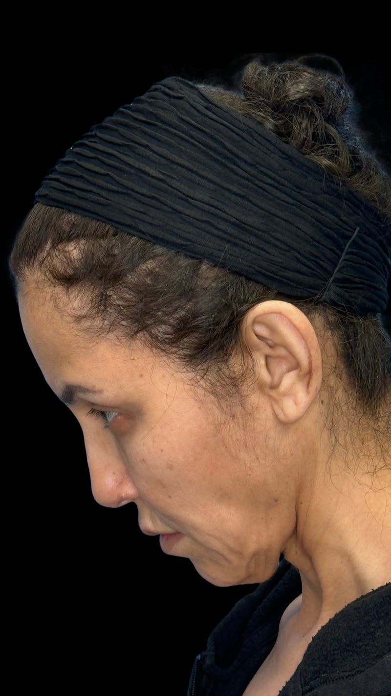 Deep Plane Facelift 50s Before & After Gallery - Patient 210718 - Image 7