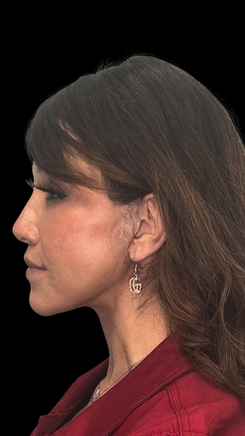 Deep Plane Facelift 50s Before & After Gallery - Patient 210718 - Image 6