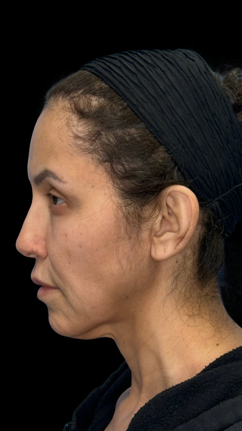Deep Plane Facelift 50s Before & After Gallery - Patient 210718 - Image 5