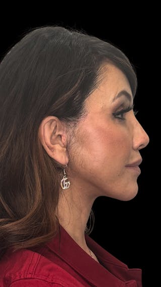 Deep Plane Facelift 50s Before & After Gallery - Patient 210718 - Image 12