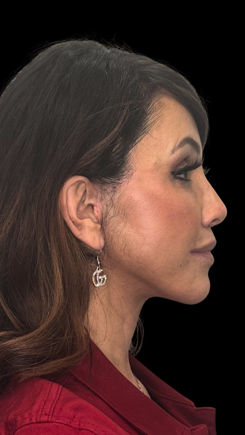 Deep Plane Facelift 50s Before & After Gallery - Patient 210718 - Image 12