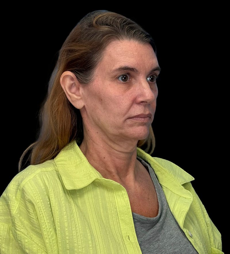 ContourLift Before & After Gallery - Patient 410035 - Image 3