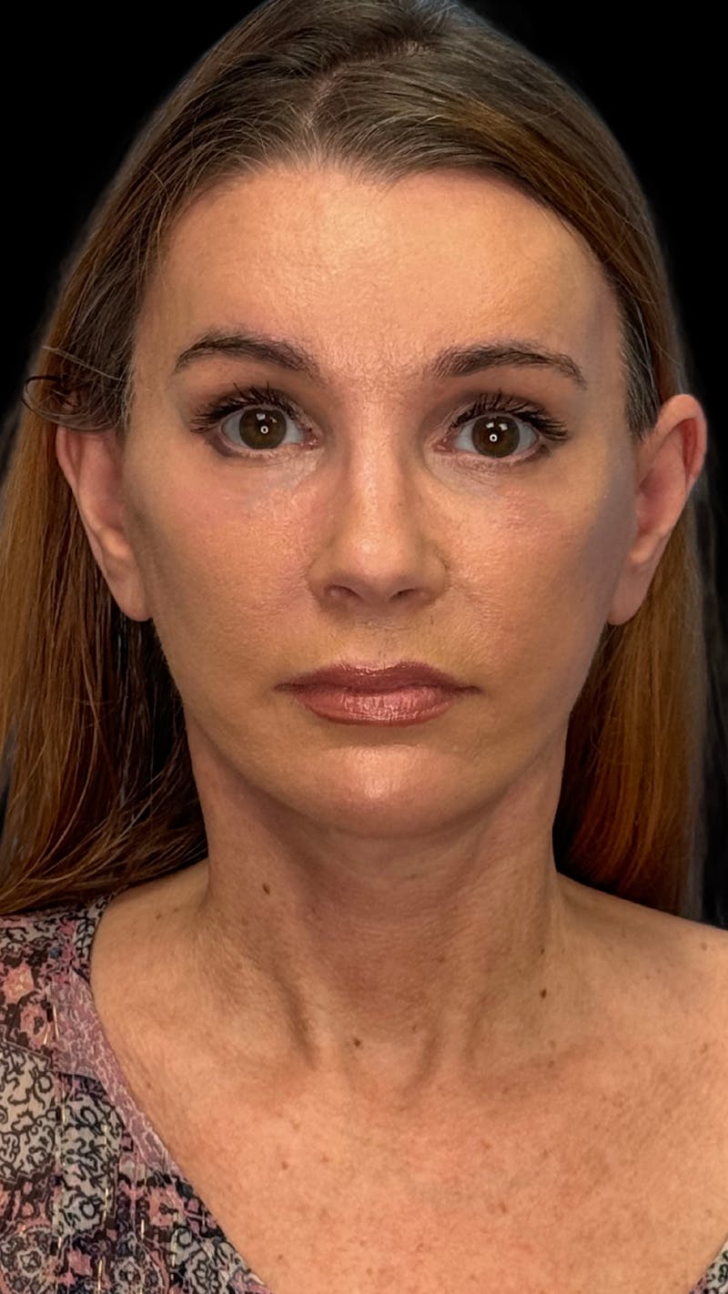 ContourLift Before & After Gallery - Patient 410035 - Image 2