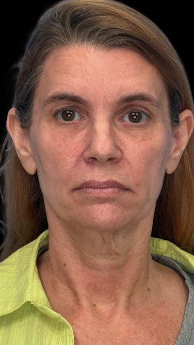 ContourLift Before & After Gallery - Patient 410035 - Image 1