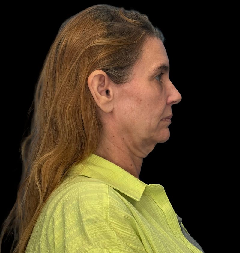 ContourLift Before & After Gallery - Patient 410035 - Image 5