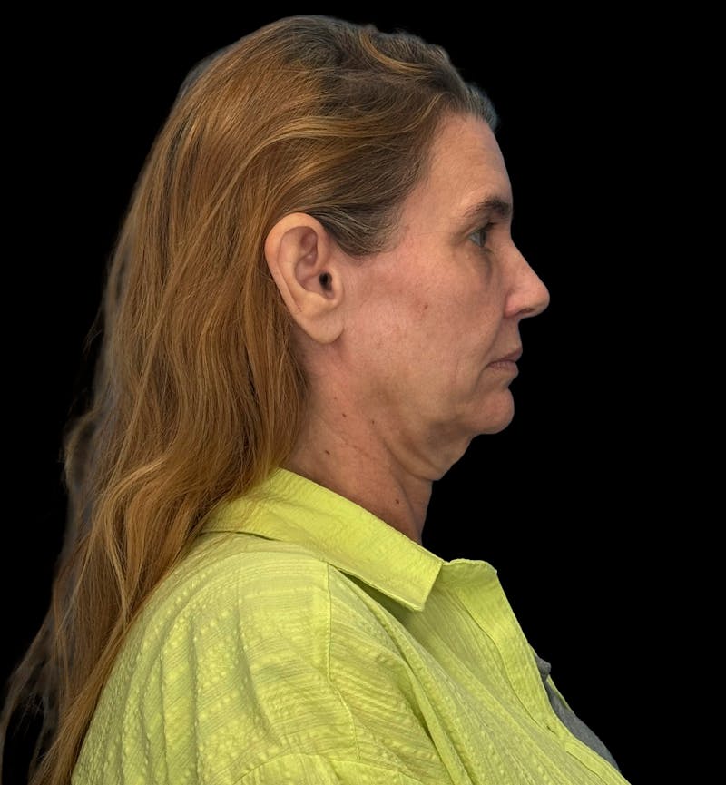 Deep Plane Facelift 50s Before & After Gallery - Patient 121791 - Image 5