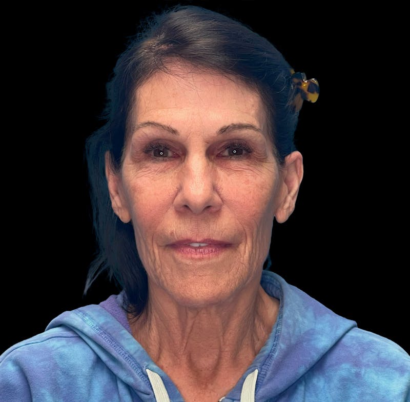 Deep Plane Facelift 70s Before & After Gallery - Patient 356352 - Image 1