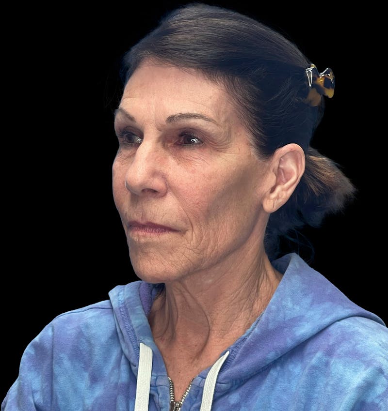Deep Plane Facelift 70s Before & After Gallery - Patient 356352 - Image 3
