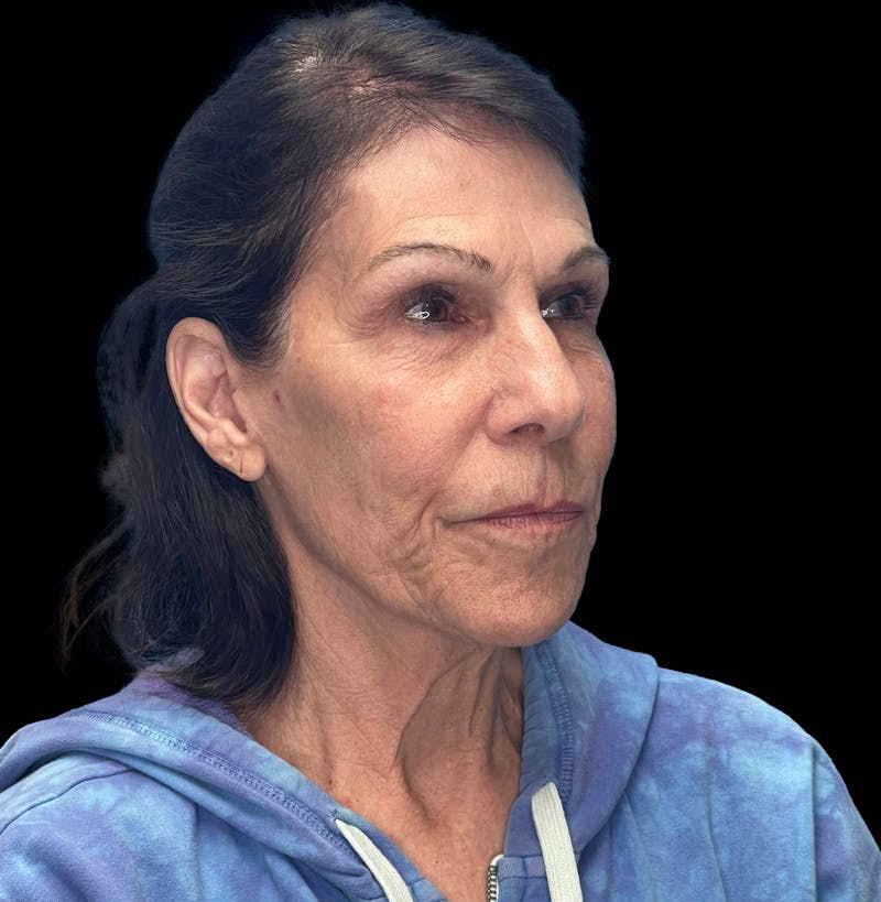 Deep Plane Facelift 70s Before & After Gallery - Patient 356352 - Image 7