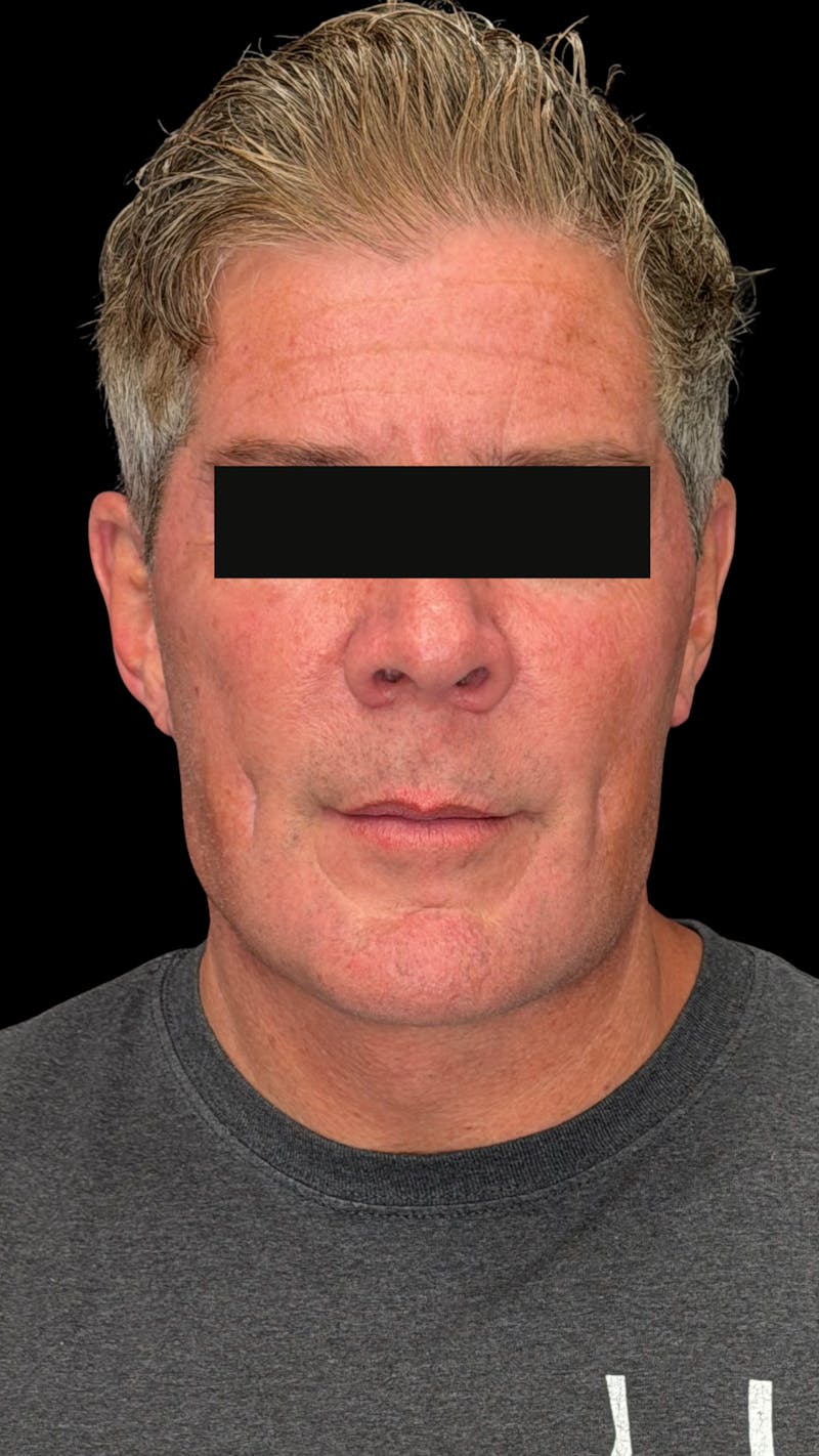 Mandibular Angle Implants Before & After Gallery - Patient 344735 - Image 4