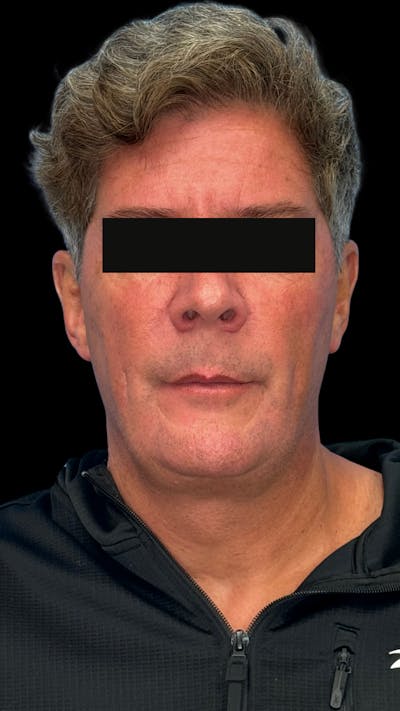 Cheek Implant Before & After Gallery - Patient 350990 - Image 1
