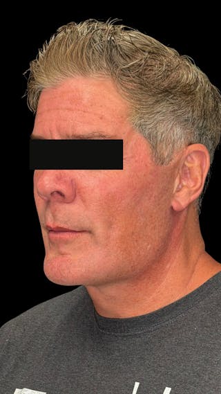 Cheek Implant Before & After Gallery - Patient 350990 - Image 8
