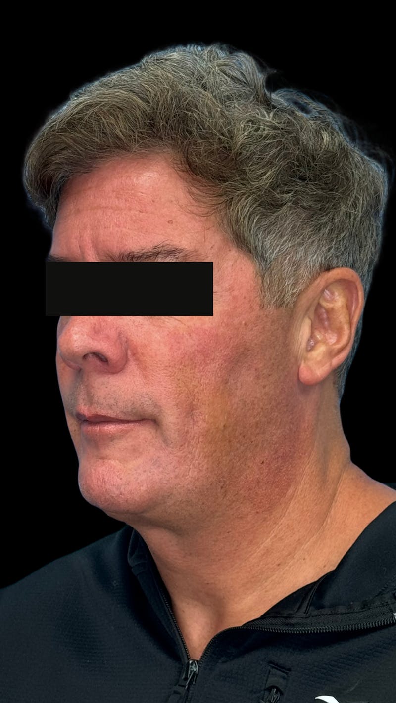 Mandibular Angle Implants Before & After Gallery - Patient 344735 - Image 9