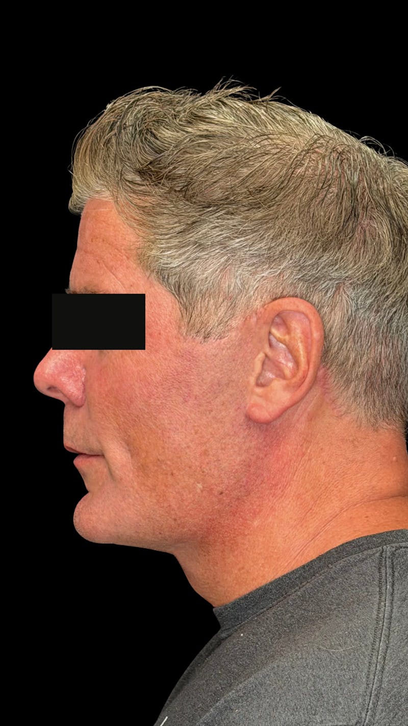 Mandibular Angle Implants Before & After Gallery - Patient 344735 - Image 2