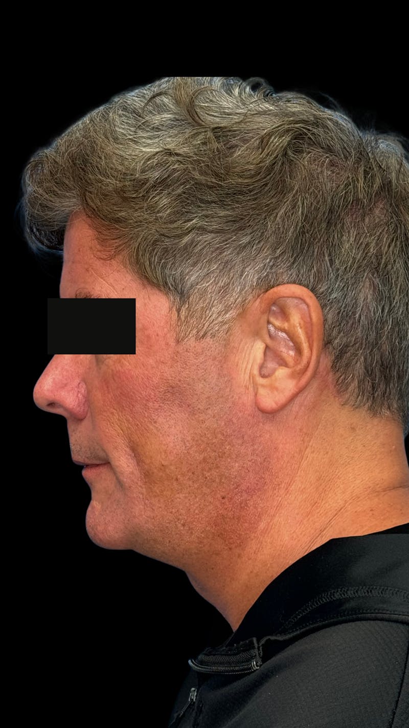 Mandibular Angle Implants Before & After Gallery - Patient 344735 - Image 1