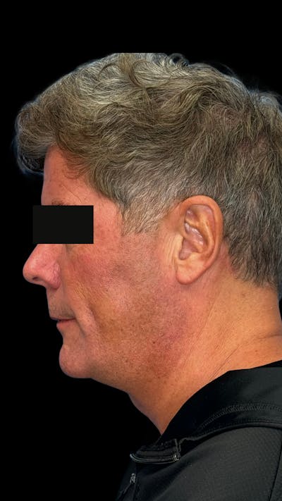 Mandibular Angle Implants Before & After Gallery - Patient 344735 - Image 1