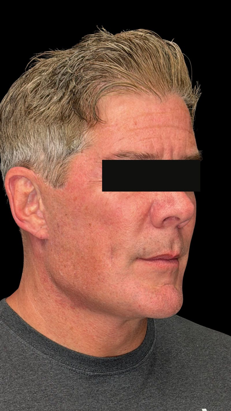 Mandibular Angle Implants Before & After Gallery - Patient 344735 - Image 6