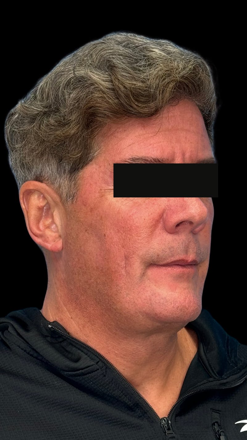 Mandibular Angle Implants Before & After Gallery - Patient 344735 - Image 5