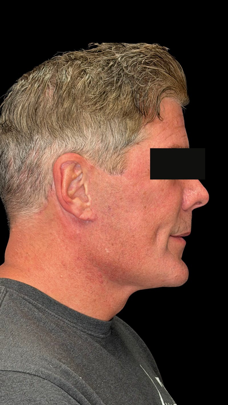 Mandibular Angle Implants Before & After Gallery - Patient 344735 - Image 8