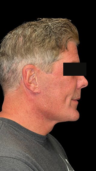 Cheek Implant Before & After Gallery - Patient 350990 - Image 6