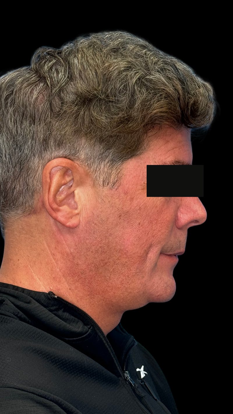 Mandibular Angle Implants Before & After Gallery - Patient 344735 - Image 7