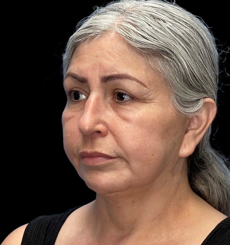 Revision Facelift Before & After Gallery - Patient 582046 - Image 3