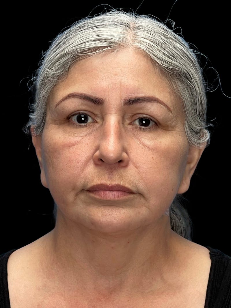 Revision Facelift Before & After Gallery - Patient 582046 - Image 5