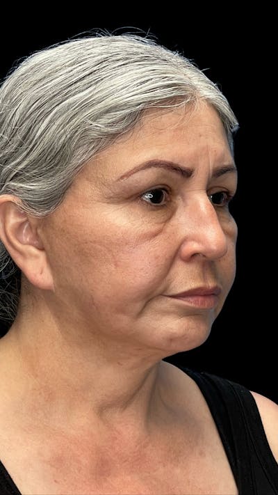 Revision Facelift Before & After Gallery - Patient 582046 - Image 1