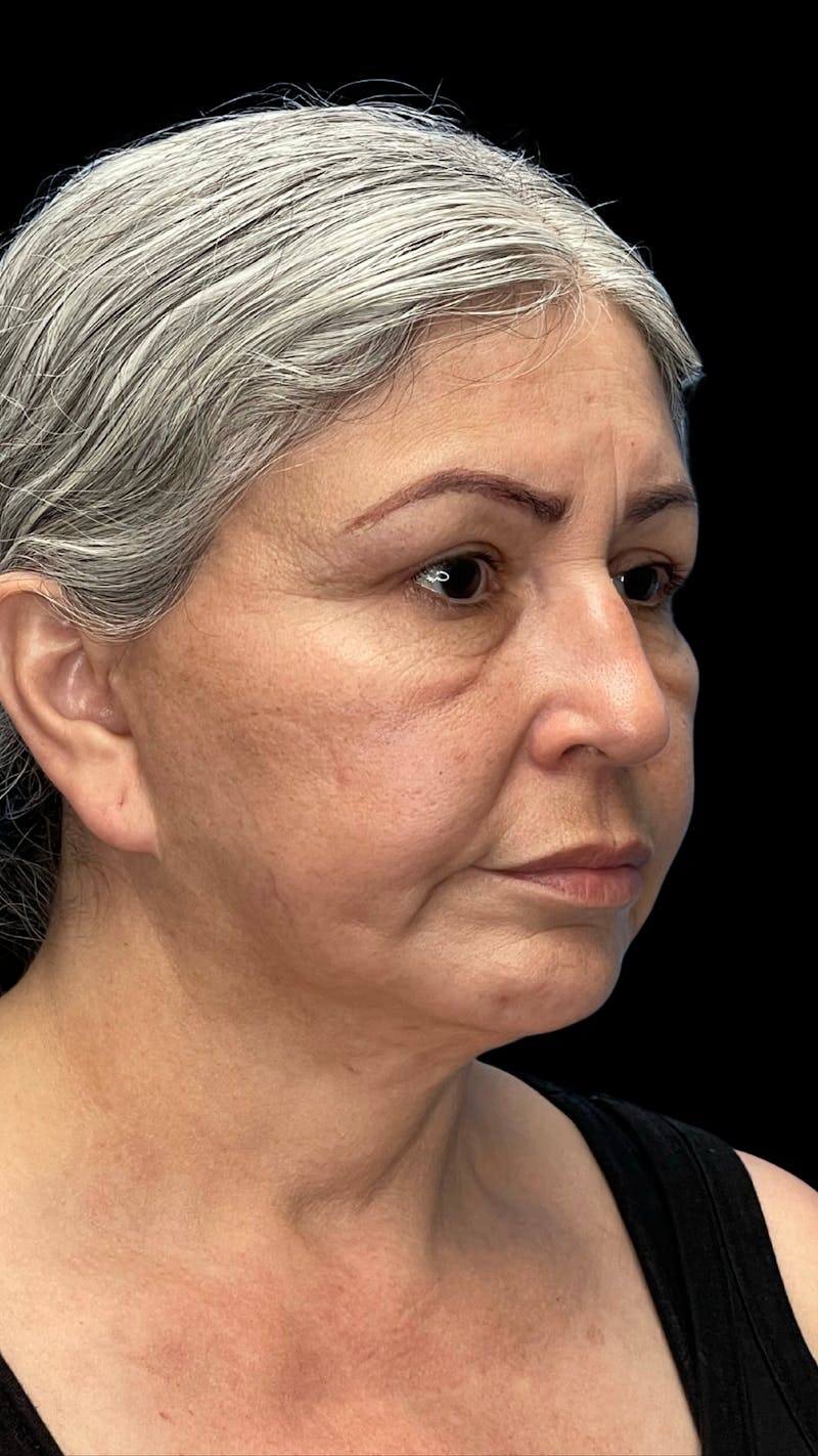 Revision Facelift Before & After Gallery - Patient 582046 - Image 1
