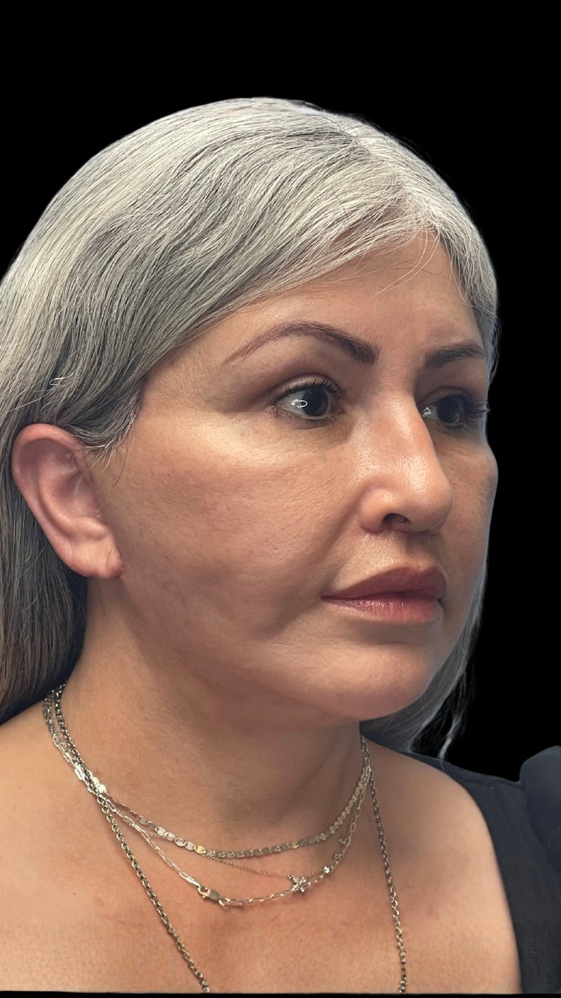Revision Facelift Before & After Gallery - Patient 582046 - Image 2