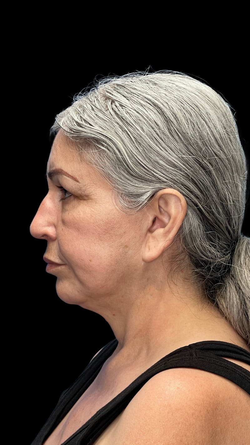 Revision Facelift Before & After Gallery - Patient 582046 - Image 9