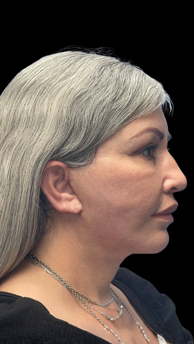Revision Facelift Before & After Gallery - Patient 582046 - Image 8