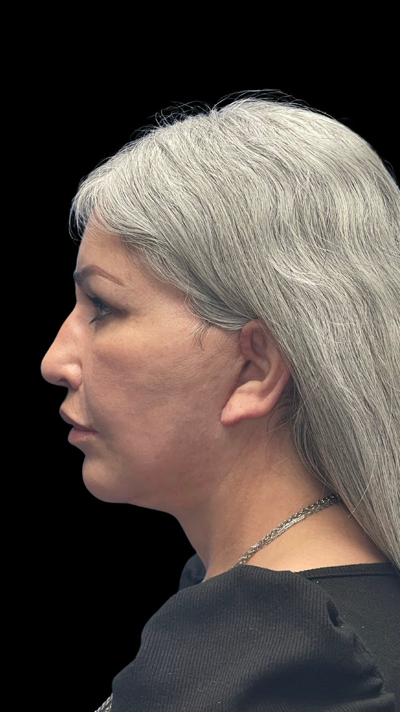 Revision Facelift Before & After Gallery - Patient 582046 - Image 10