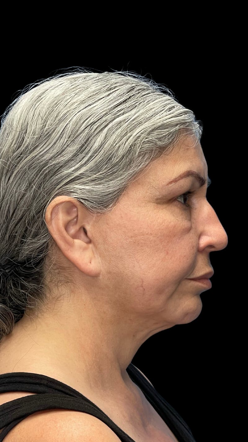 Revision Facelift Before & After Gallery - Patient 582046 - Image 7