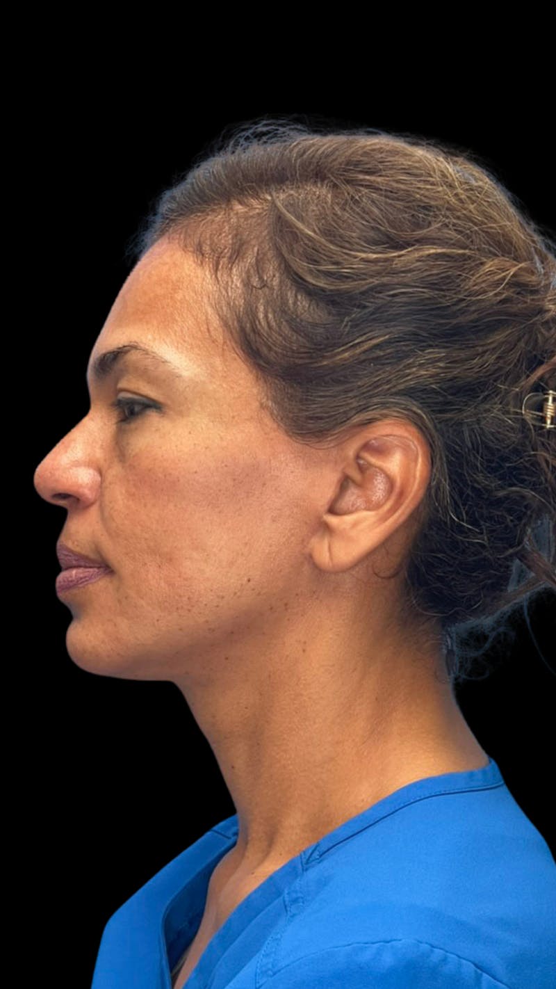 ContourLift Before & After Gallery - Patient 361287 - Image 10