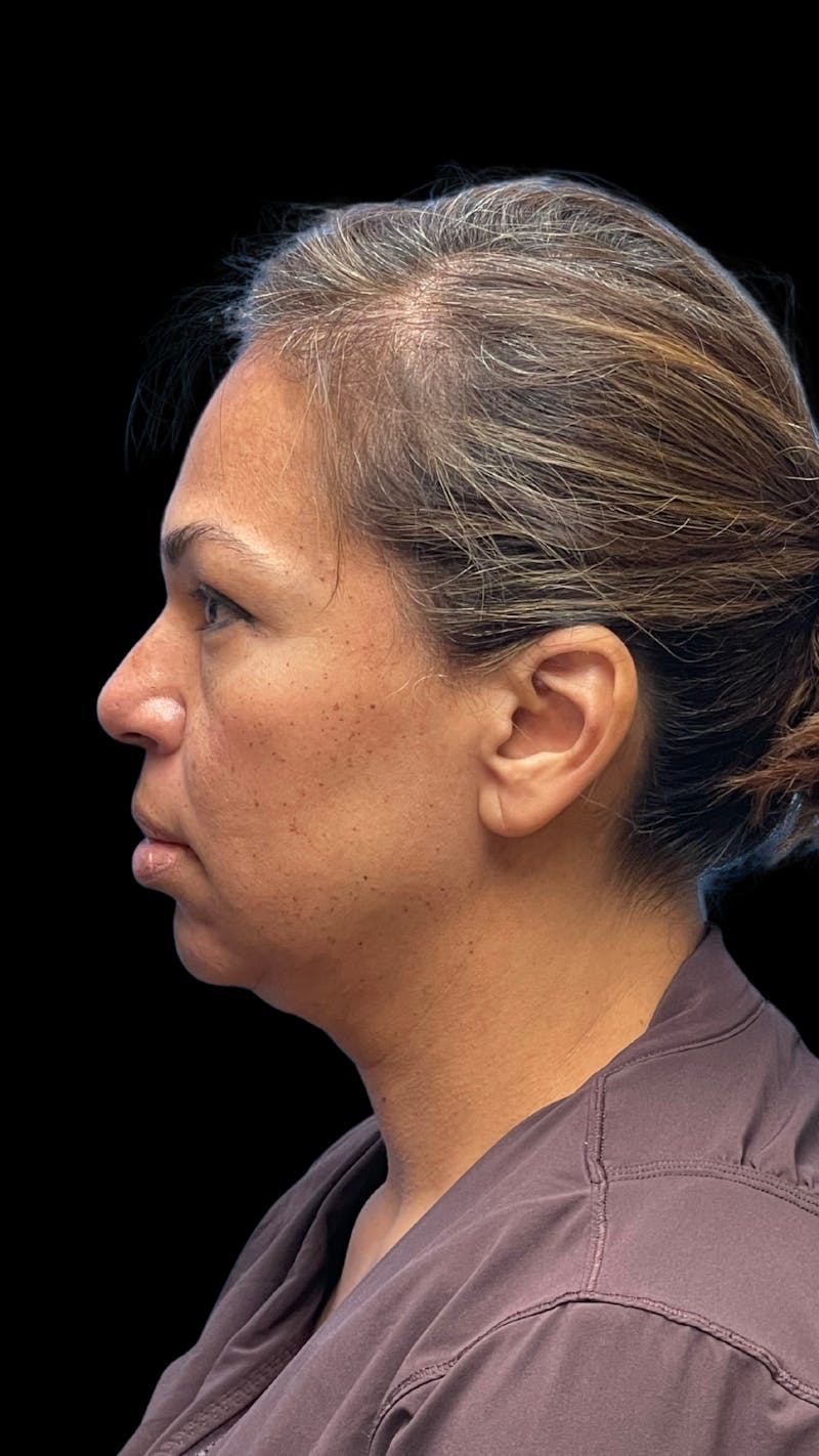ContourLift Before & After Gallery - Patient 361287 - Image 9