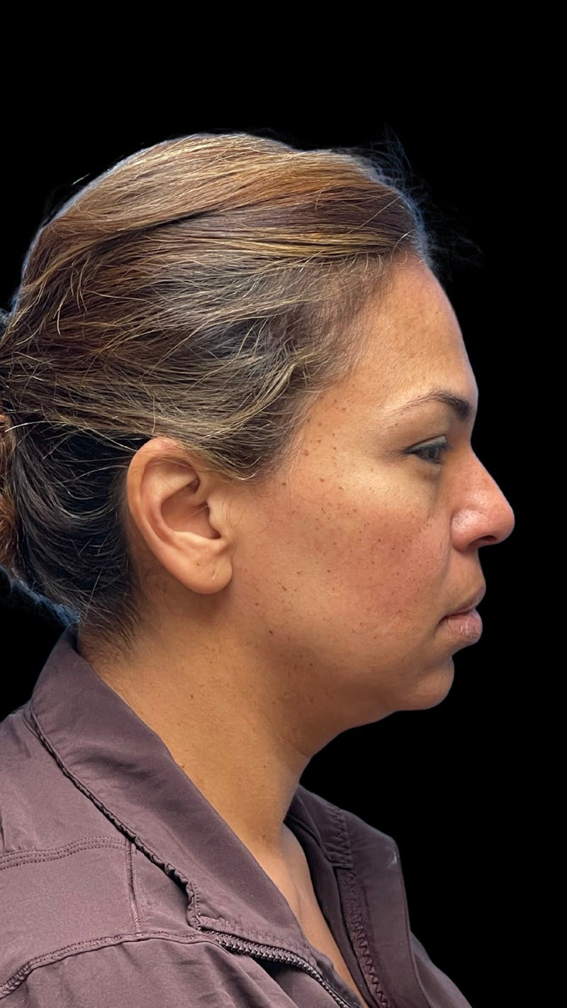 ContourLift Before & After Gallery - Patient 361287 - Image 5