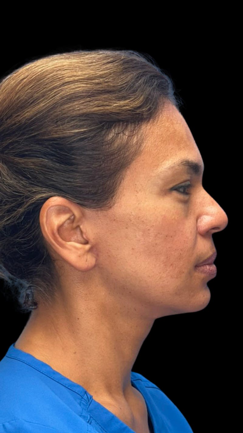 ContourLift Before & After Gallery - Patient 361287 - Image 6