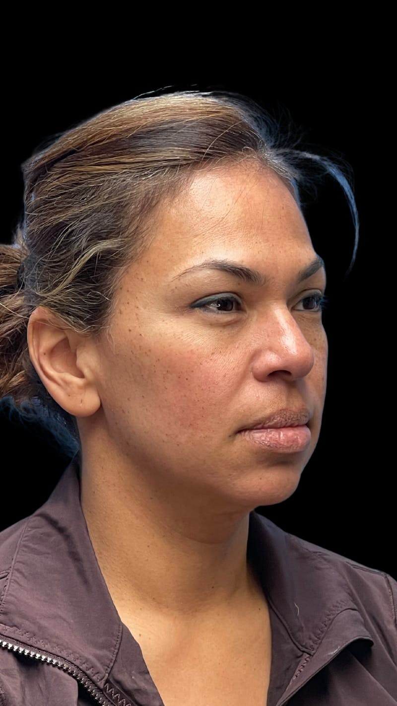 ContourLift Before & After Gallery - Patient 361287 - Image 3