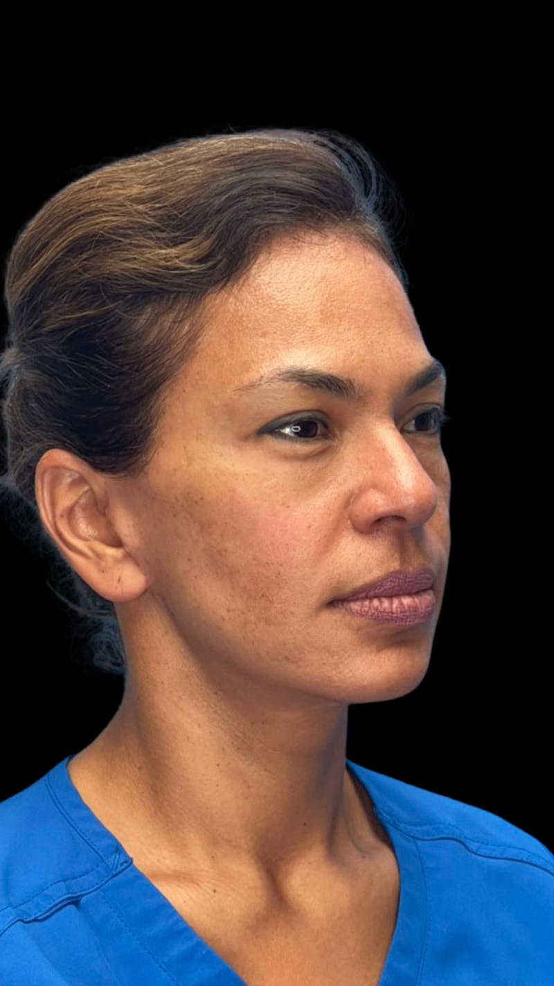 ContourLift Before & After Gallery - Patient 361287 - Image 4