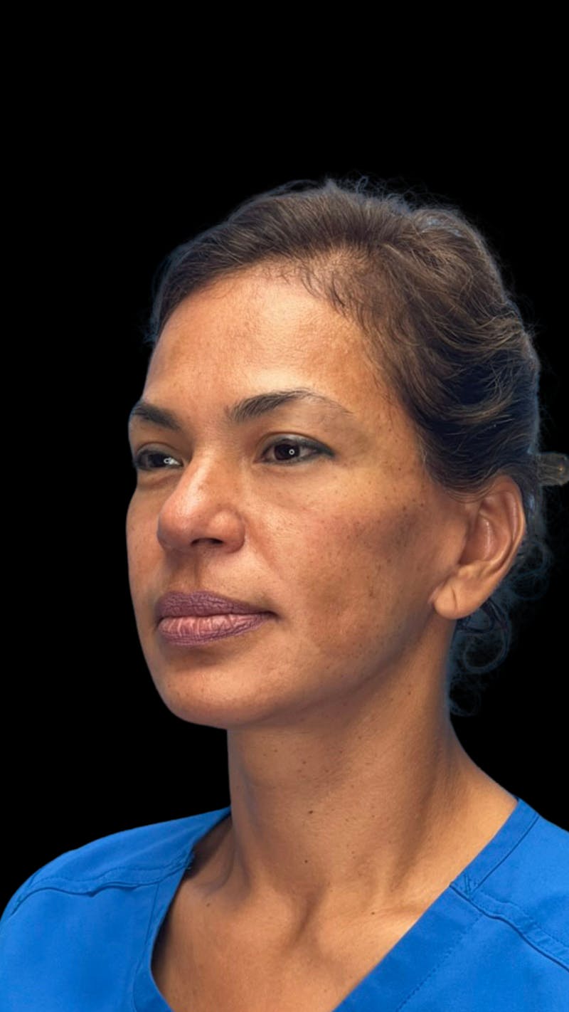 ContourLift Before & After Gallery - Patient 361287 - Image 8